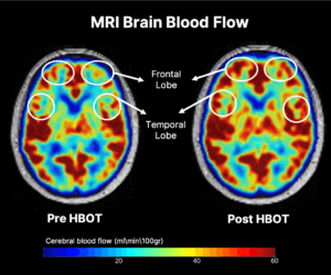 New Hyperbaric Therapy Could Limit and Perhaps Reverse Cognitive Decline