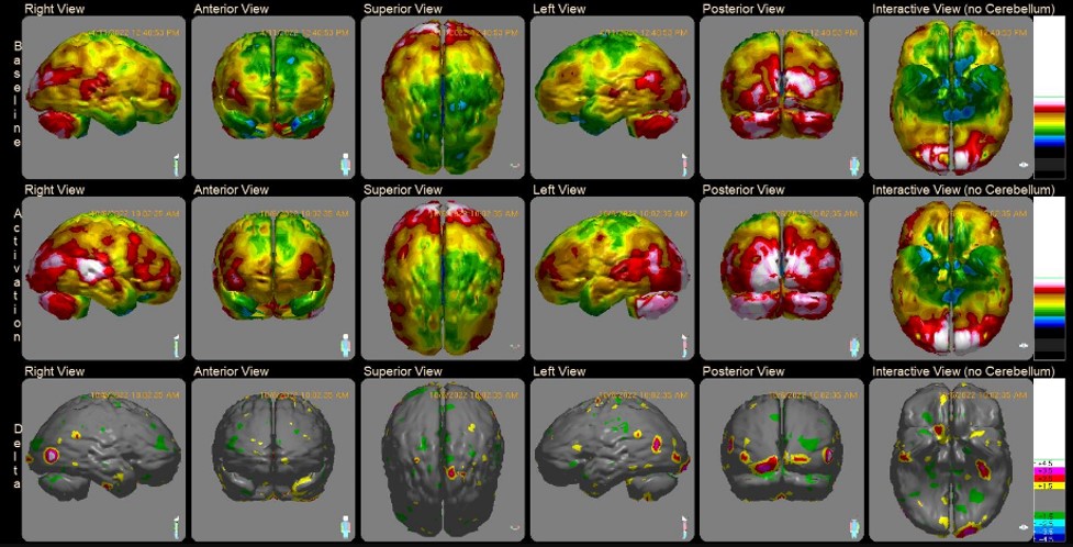 spect-scan